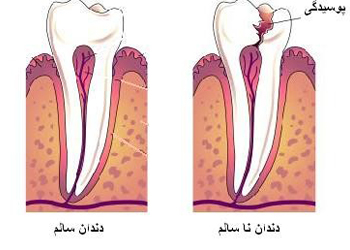 پوسیدگی دندان و جلوگیری از آن