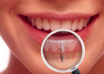 ایمپلنت دندان چیست ؟ عوارض و فواید ایمپلنت