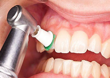 جرم گیری دندان ، عوارض و فواید جرم گیری دندان